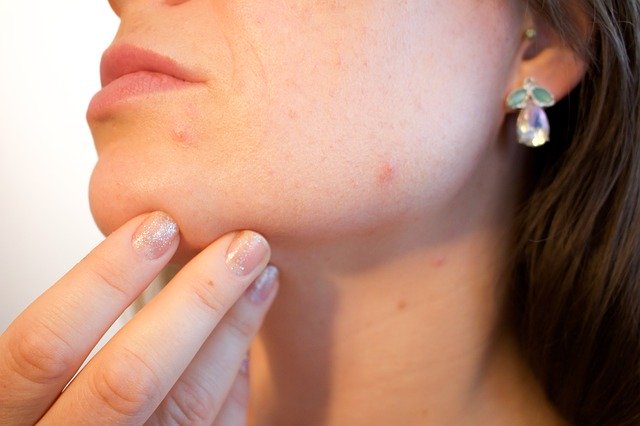 Cum tratăm acneea