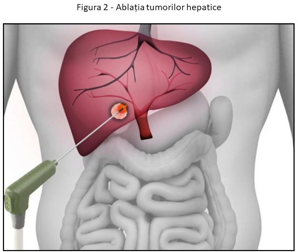 Figura 2 - Ablatia tumorilor hepatice