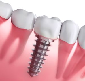 implant dentar clasic