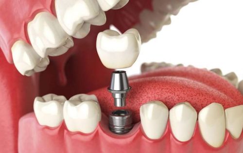 De ce să alegi implantul dentar de la Dental Premier
