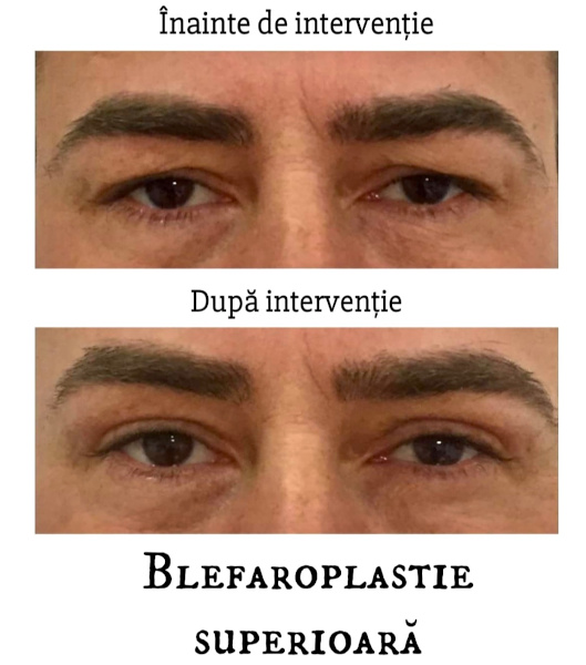 blefaroplastie - Iancu Morad - Lluxury
