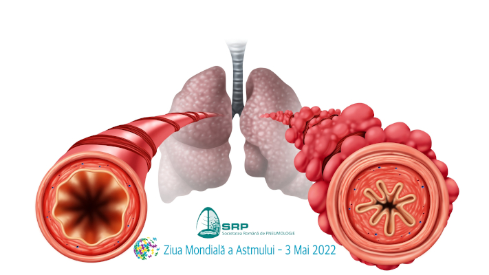 Astmul netratat înseamnă suferință pentru pacienți și costuri mai mari pentru sistemul de sănătate